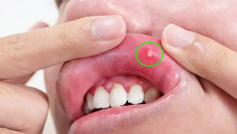 B Vitamini Eksikliği: Vücudunuzda Belirgin Belirtilerle Karşılaşabilirsiniz!
